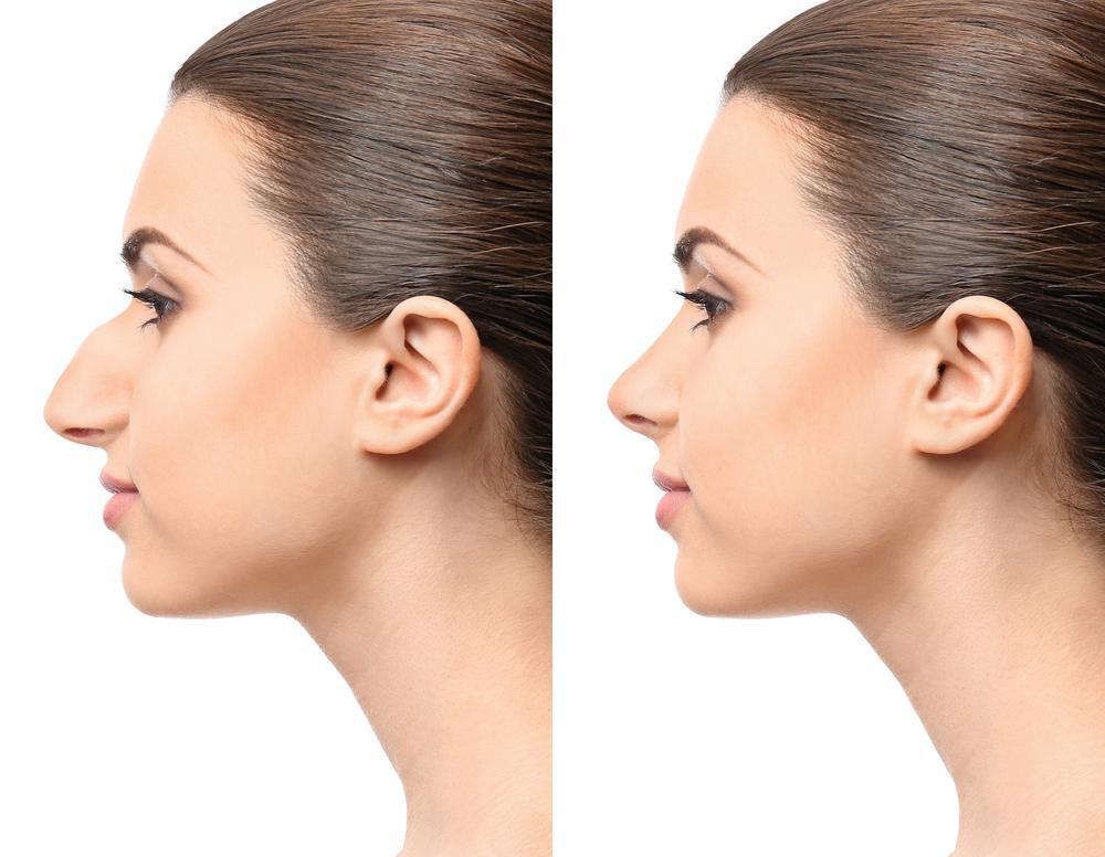 faq-rhinoplastie-tunisie