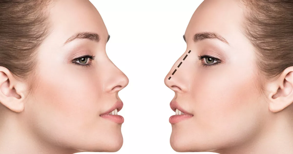 rhinoplastie-tunisie