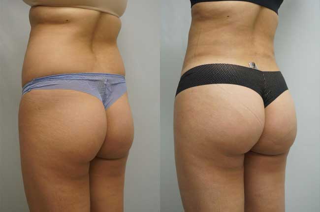 augmentation-fesses-implant-avant-apres