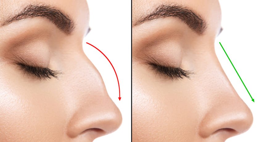 rhinoplastie-secondaire