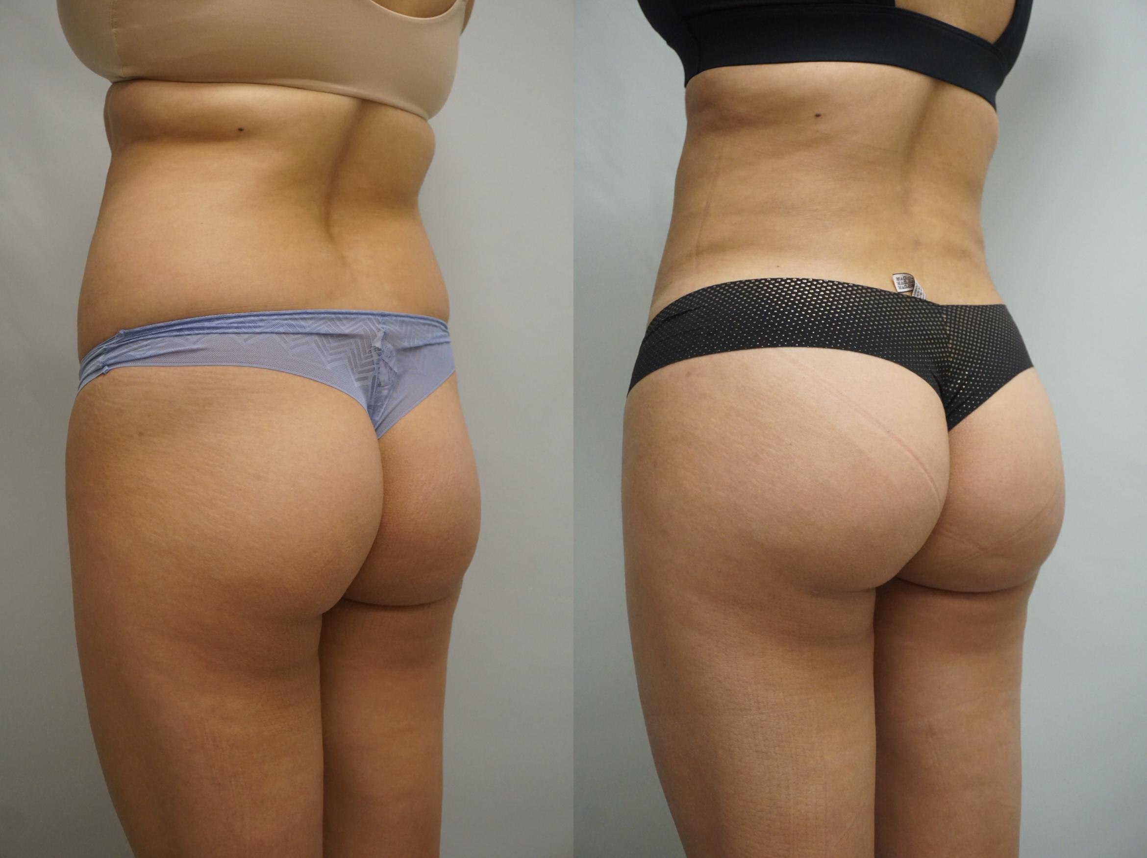 augmentation-fesses-tunisie